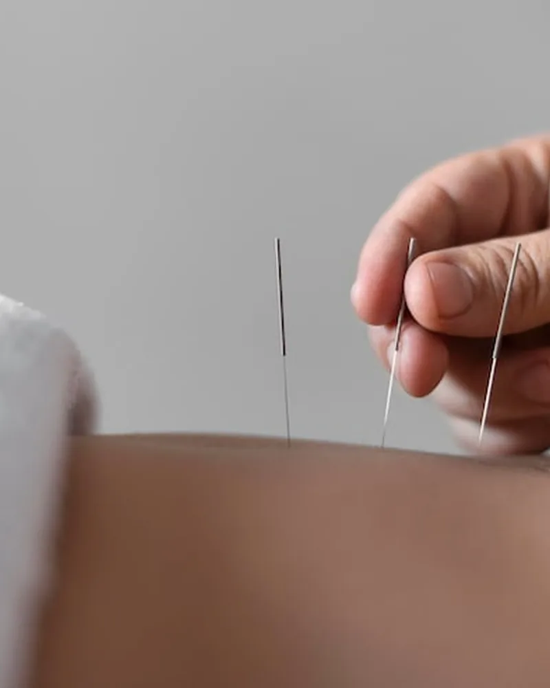 Licensed physical therapist performing dry needling on a patient's shoulder in Lake Charles