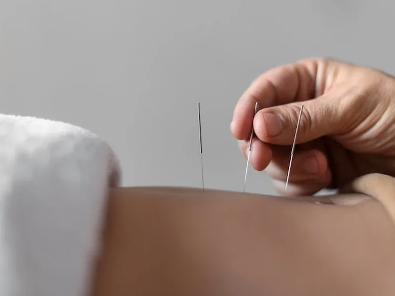 Dry Needling at Hope Therapy Center